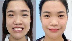 Mặt lệch do xương nên tìm bác sĩ nào? Có cần chỉnh nha