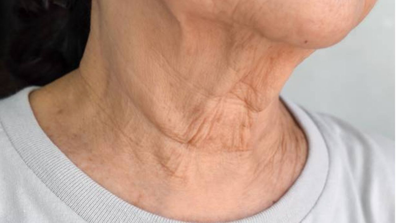 Da cổ chùng nhão và nhiều nếp nhăn là những dấu hiệu lão hóa thường được quan tâm khi lựa chọn phương pháp nâng cơ, trẻ hóa vùng cổ.