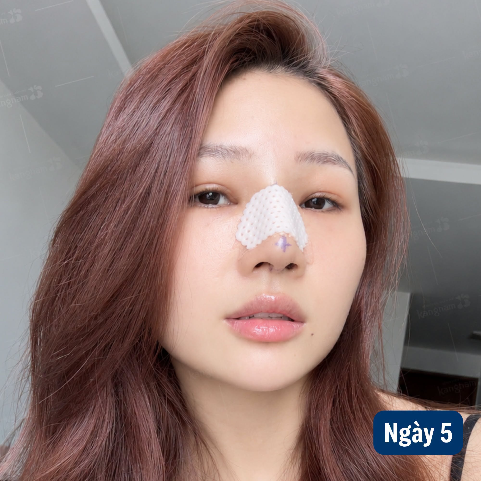 Trong những ngày đầu sau nâng mũi, tình trạng sưng nề bên trong có thể khiến người bệnh cảm thấy nghẹt hoặc khó thở qua mũi.