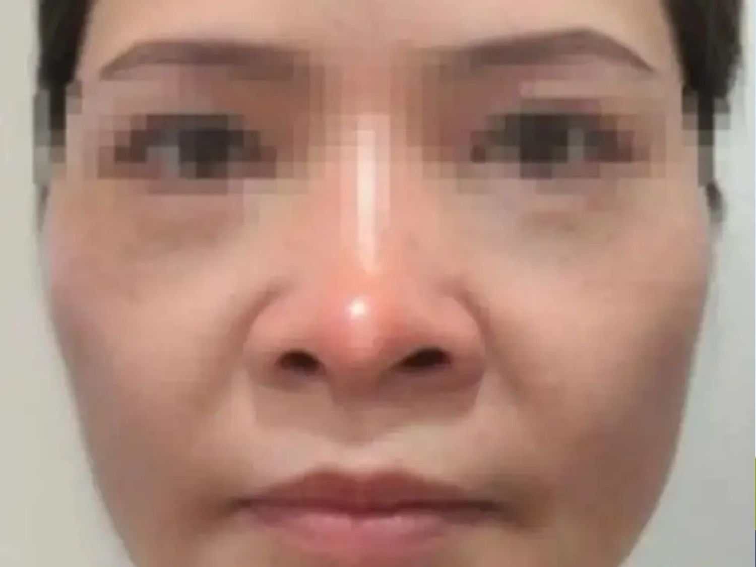 tình trạng Đầu mũi đỏ rực hoặc ửng hồng liên tục