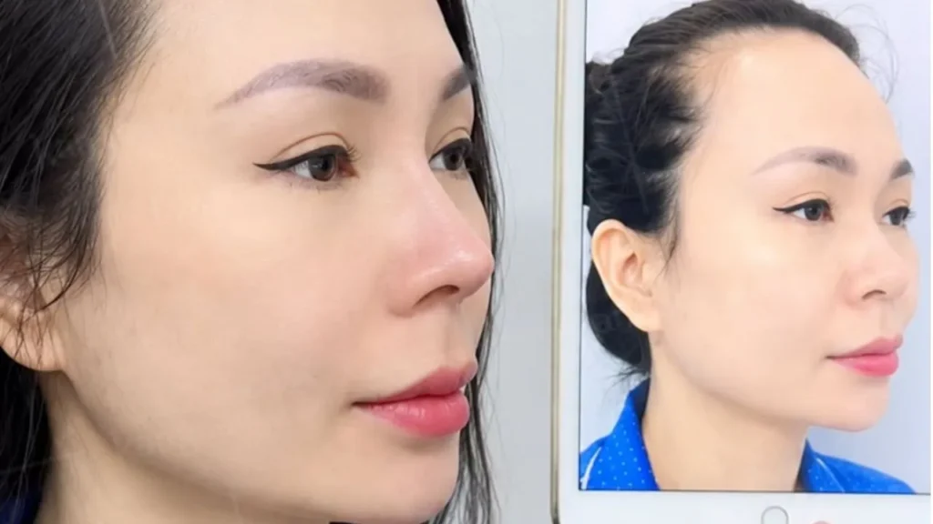 Nâng mũi giữ được bao lâu, có vĩnh viễn không?