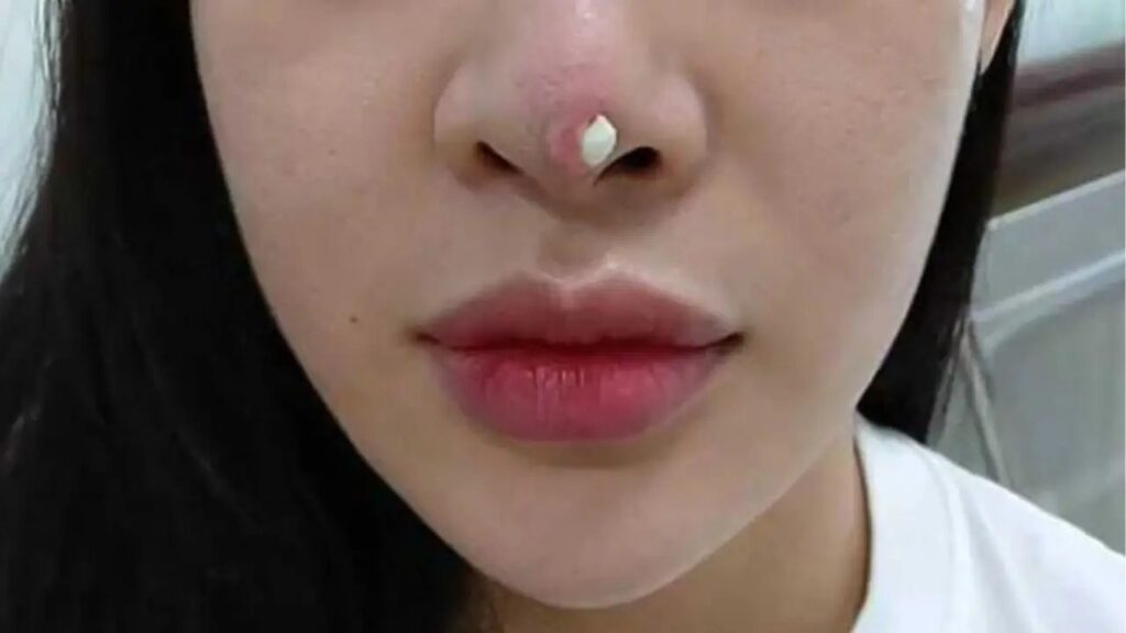Nâng mũi bị hỏng thì cơ sở có chịu trách nhiệm không?