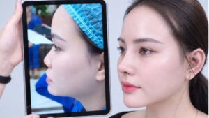 Nâng mũi có trả góp được không, thủ tục thế nào?