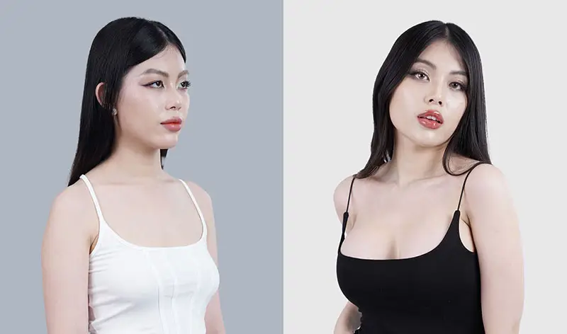 Tham khảo cấy mỡ ngực kết hợp đặt túi độn ngực