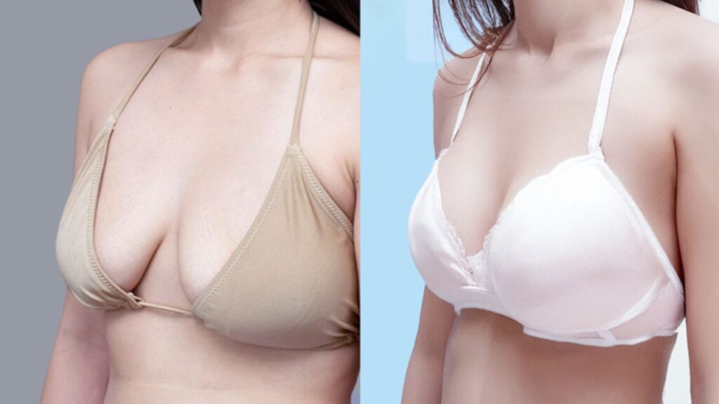 Nâng ngực kết hợp treo giá bao nhiêu? Bảng giá combo đặt túi và treo sa trễ