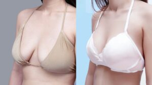 Nâng ngực kết hợp treo giá bao nhiêu? Bảng giá combo đặt túi và treo sa trễ