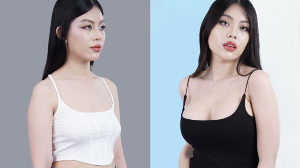 Nâng ngực ở đâu uy tín TP.HCM? Khám phá địa chỉ nâng ngực an toàn tại Sài Gòn