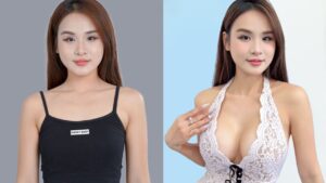 Nâng ngực giá TP.HCM bao nhiêu tiền? Bảng giá theo loại túi và phương pháp