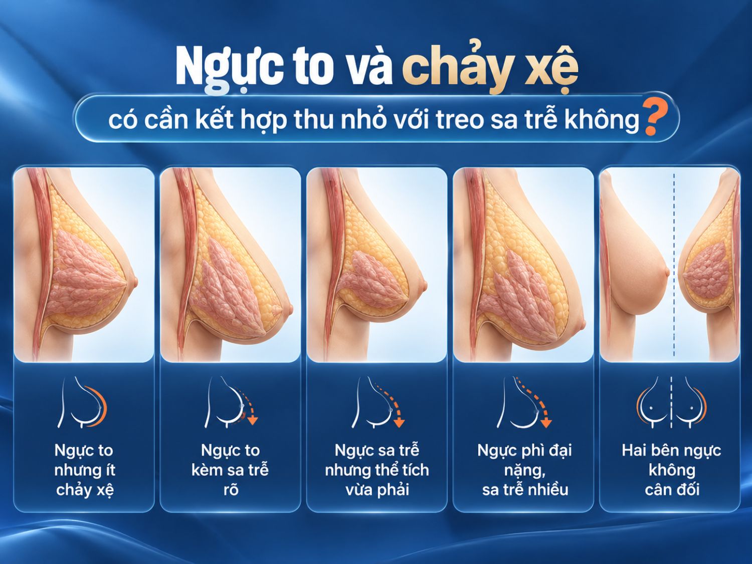 Việc kết hợp thu nhỏ ngực và treo sa trễ phụ thuộc vào thể tích mô tuyến, mức độ chảy xệ và sự cân đối hai bên ngực. Bác sĩ sẽ thăm khám để xác định có cần loại bỏ mô vú dư thừa, nâng vị trí núm vú và tạo hình lại bầu ngực hay không.