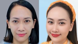 Người gầy cấy mỡ chi phí bao nhiêu? Lấy mỡ nhiều vùng có đắt hơn không?