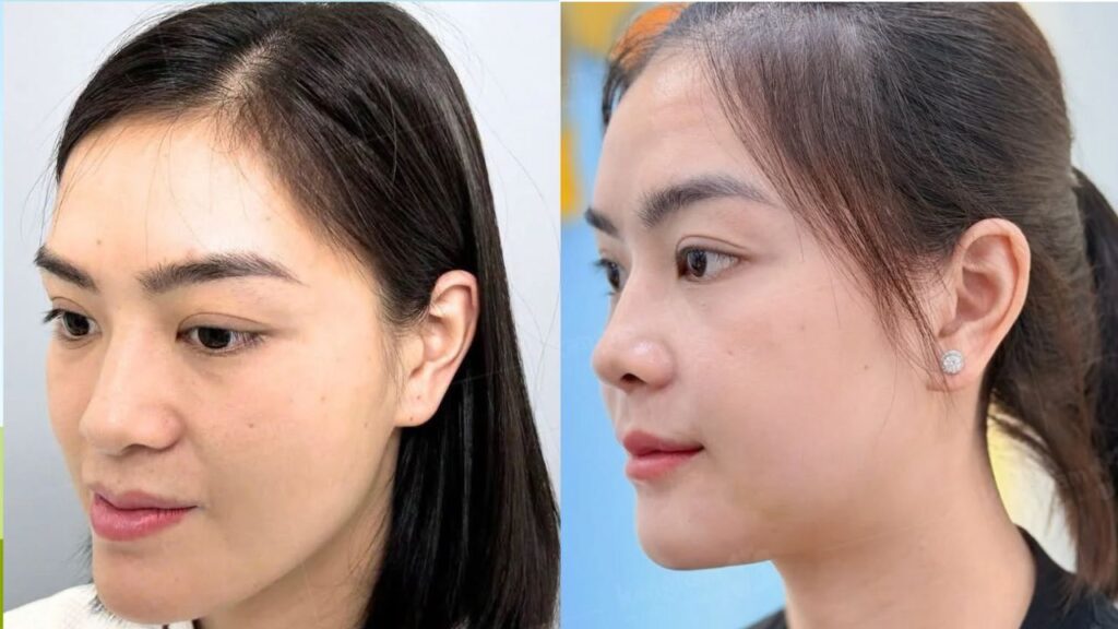 Phẫu thuật hàm móm ở đâu tại TP.HCM an toàn, uy tín?