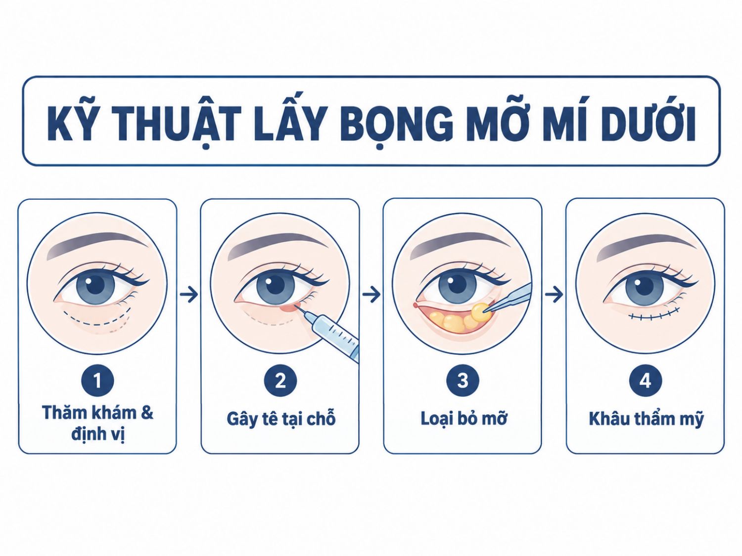 ảnh mô tả Kỹ thuật lấy bọng mỡ mí dưới