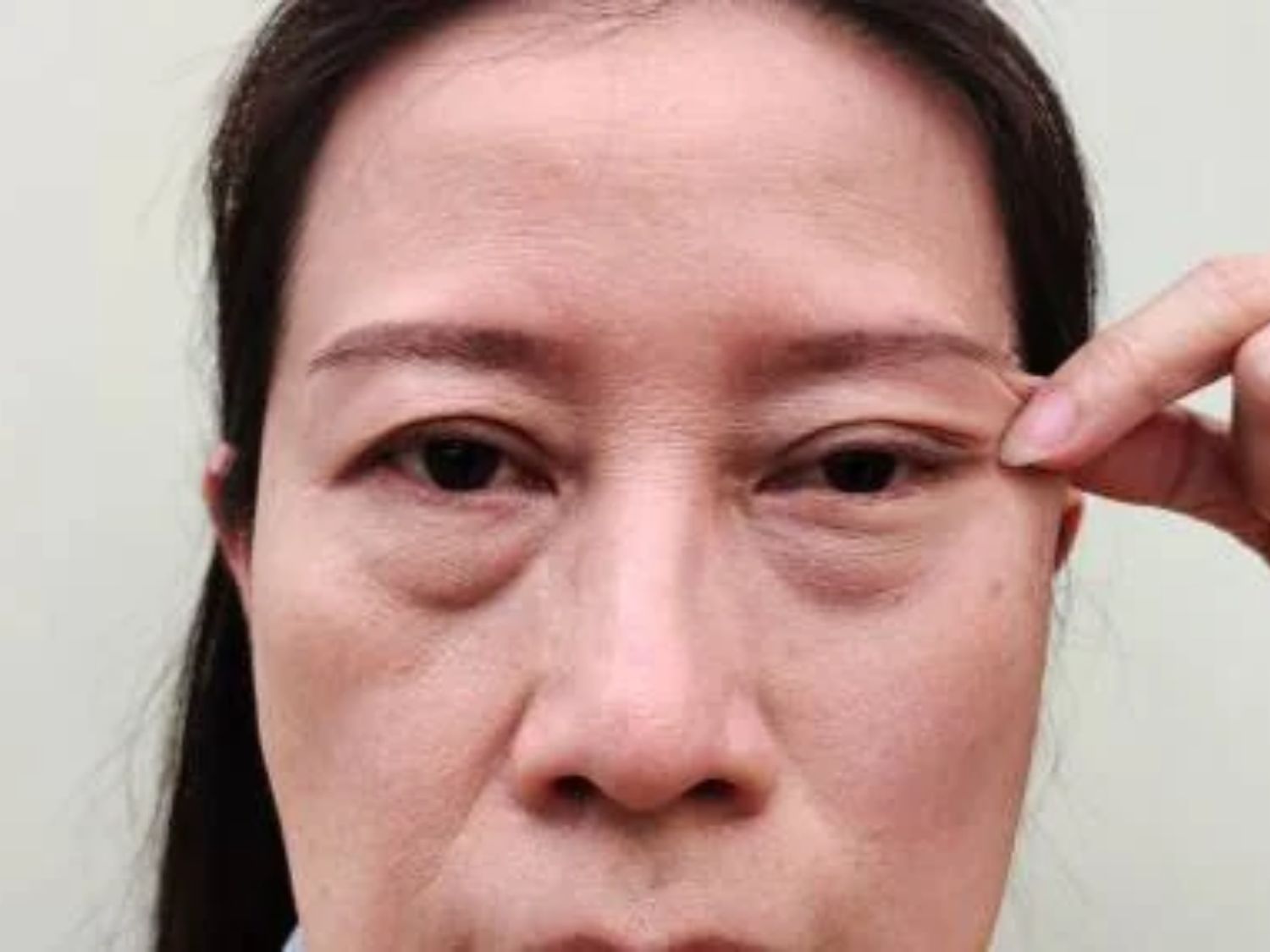 Người có đôi mắt mệt mỏi, bọng mắt to bẩm sinh