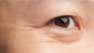 Phòng khám thẩm mỹ có được lấy bọng mỡ mí dưới không?