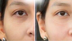 Quy trình làm trẻ hóa vùng mắt tại Kangnam gồm những bước nào? Có khám trước không?