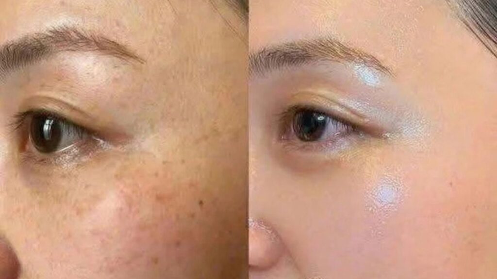 Review trị nám có thật không? Cách nhận biết ảnh trước – sau đáng tin