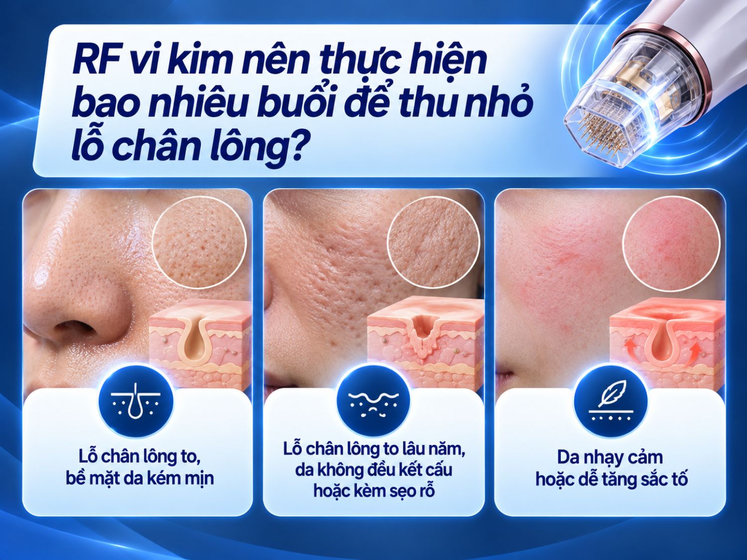Số buổi RF vi kim cần thực hiện được bác sĩ cân nhắc dựa trên mức độ lỗ chân lông to, tình trạng sẹo rỗ, kết cấu da và độ nhạy cảm của da. Mỗi khách hàng có thể cần liệu trình khác nhau để cải thiện bề mặt da.
