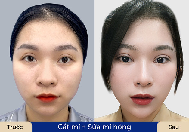Ảnh trước và sau của khách sửa mí hỏng tại Kangnam