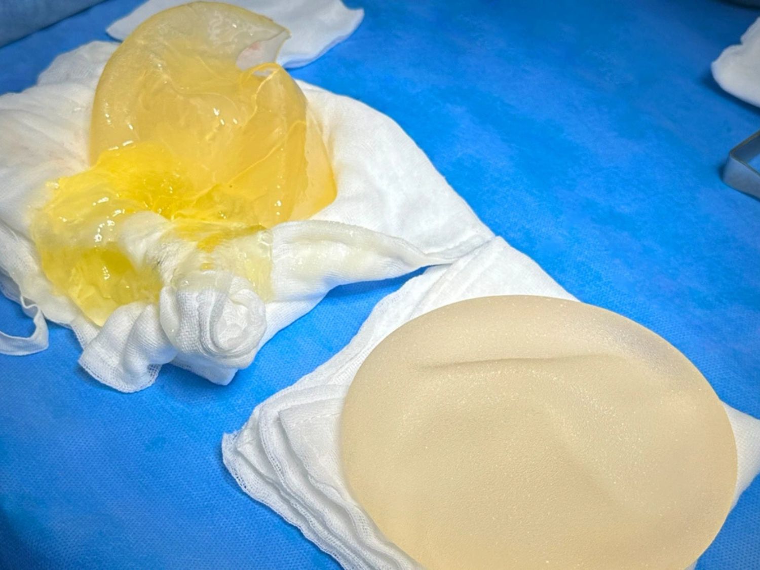 Túi ngực bị vỡ có thể khiến gel silicone thoát ra ngoài vỏ túi. Bác sĩ cần đánh giá tình trạng túi và mô xung quanh để quyết định phương án tháo túi, xử lý silicone và bóc bao xơ khi cần thiết.