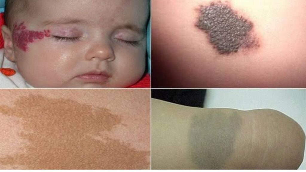 Thủ tục điều trị bớt bẩm sinh cho trẻ: Cần giấy tờ gì, bố mẹ có phải ký cam kết?