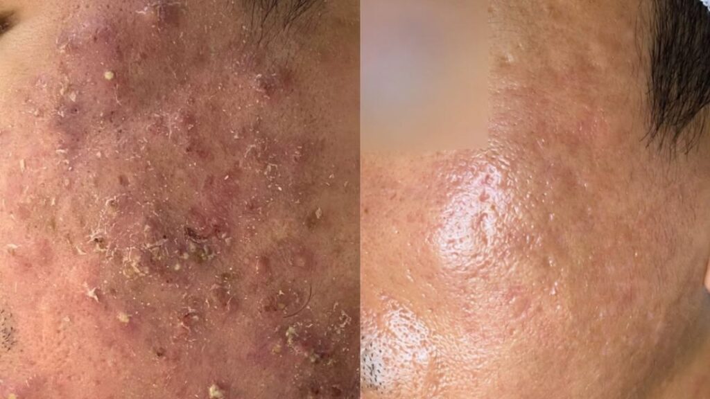 Trị mụn và thâm cùng lúc ở đâu? Giải pháp tại Bệnh viện Thẩm mỹ Kangnam