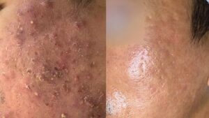 Trị mụn và thâm cùng lúc ở đâu? Giải pháp tại Bệnh viện Thẩm mỹ Kangnam