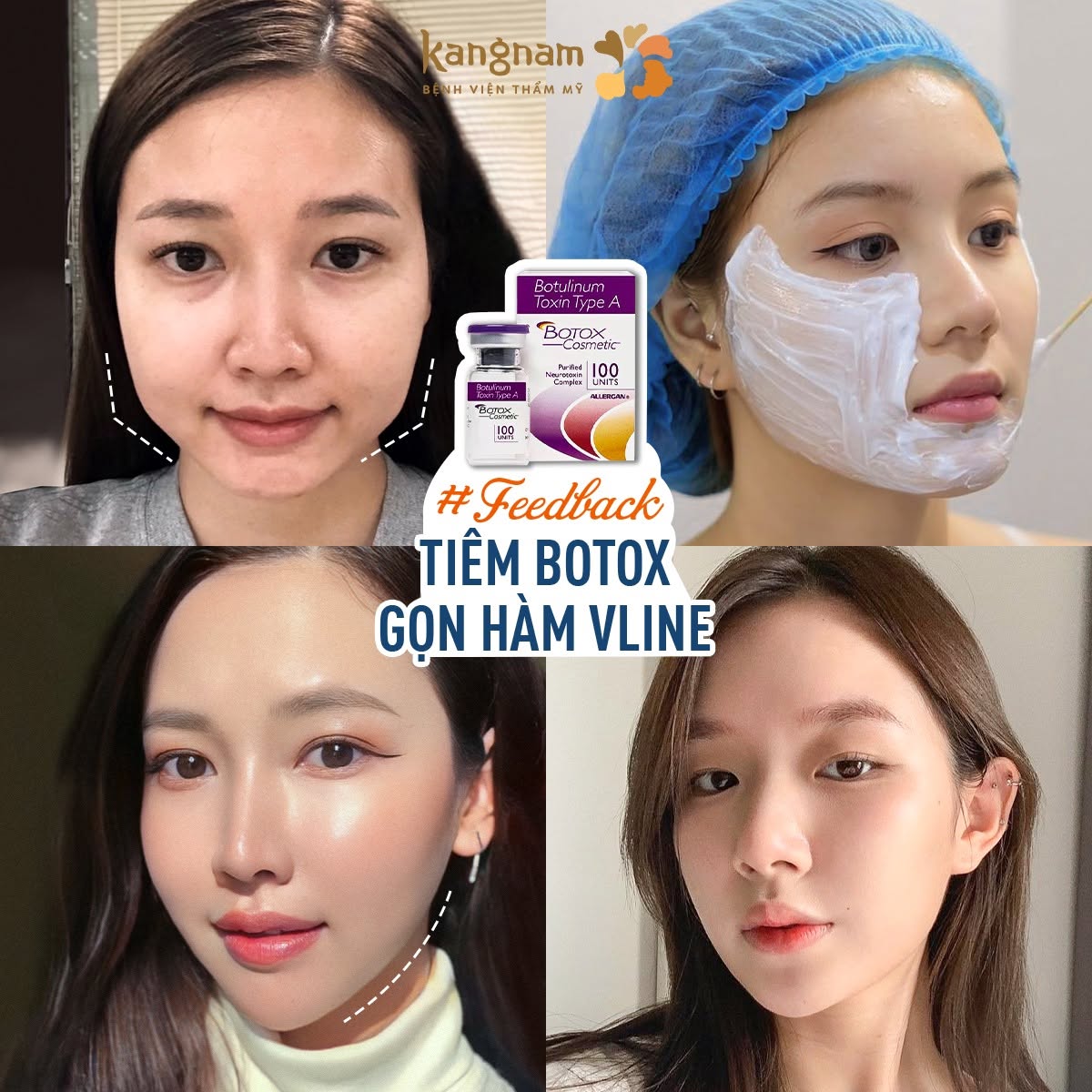 Hình ảnh trước và sau tiêm Botox gọn hàm, giúp đường viền hàm trông thanh thoát và cân đối hơn.