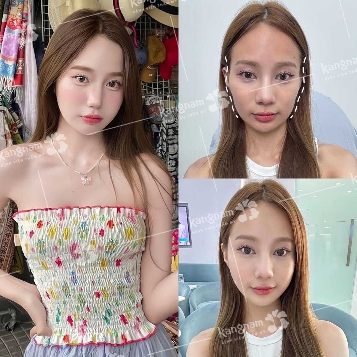 Hình ảnh so sánh diện mạo khách hàng trước và sau khi thực hiện dịch vụ trẻ hóa gương mặt tại Kangnam, với đường nét khuôn mặt có sự thay đổi rõ rệt.