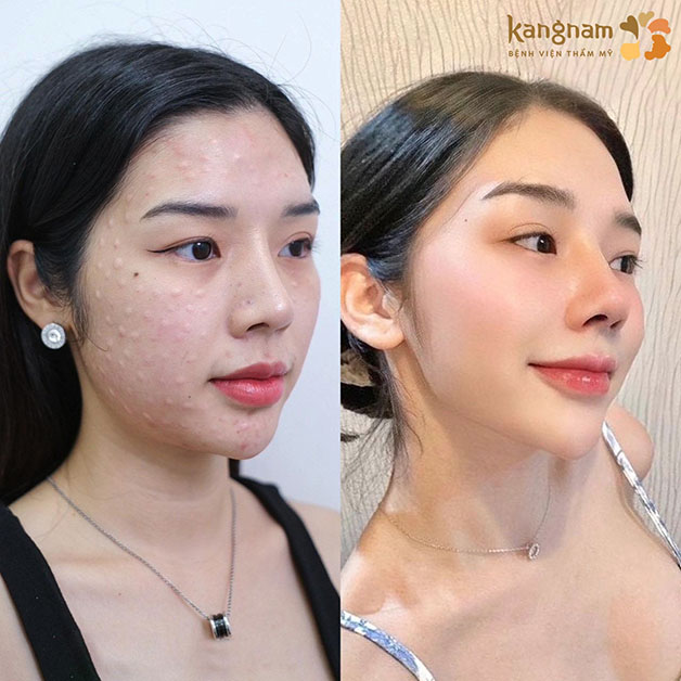 Ảnh trước - sau của khách tiêm meso trẻ hóa tại Kangnam