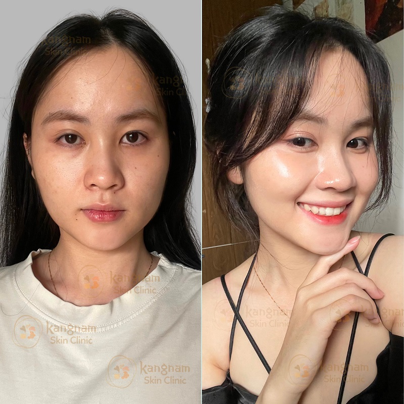 Thực hiện 1 buổi tiêm Mesotherapy giúp da sáng khỏe, ảnh trước và sau khi tiêm