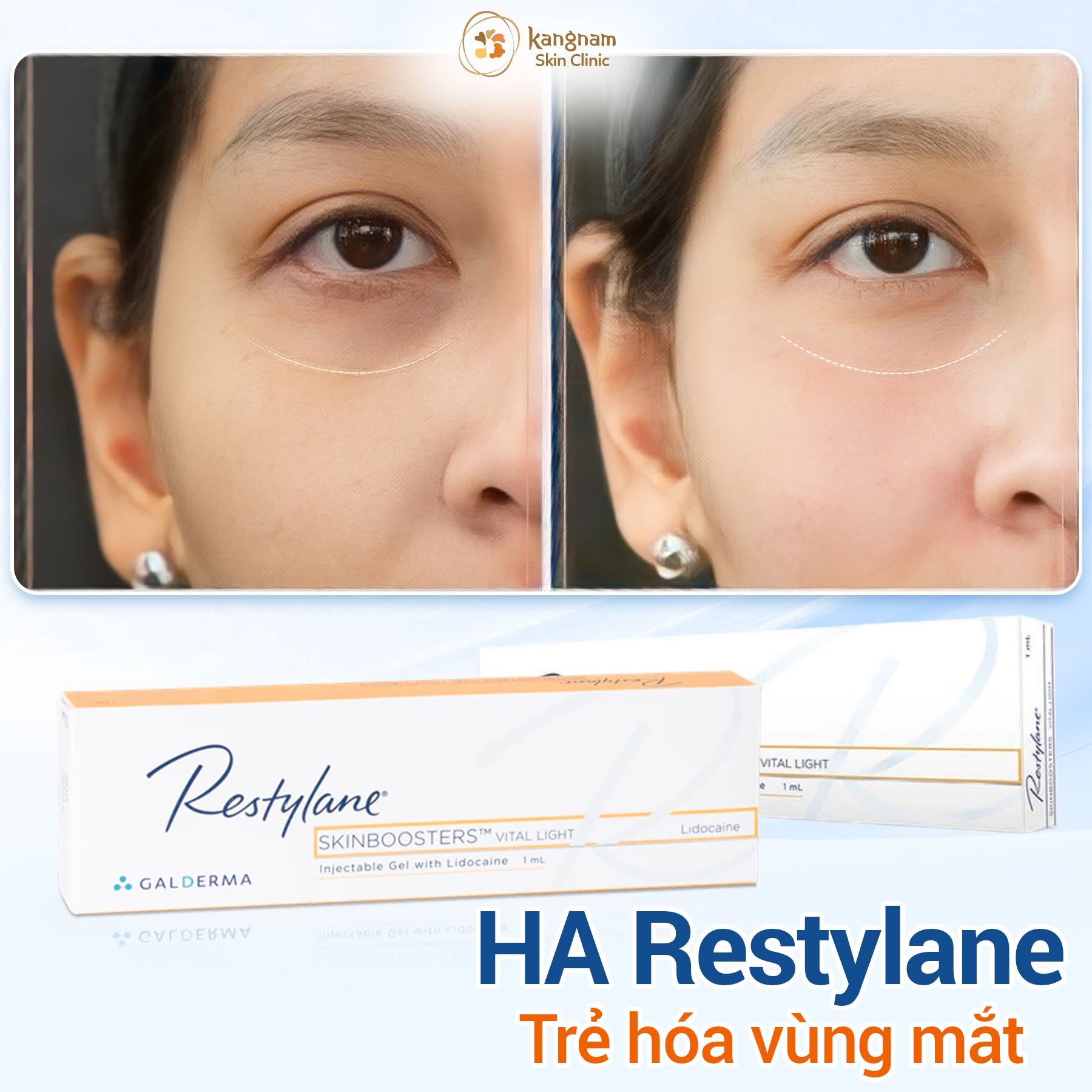 HA Restylane Skinboosters được sử dụng trong các liệu trình cải thiện độ ẩm, chất lượng da và hỗ trợ làm mờ nếp nhăn nhỏ quanh mắt theo chỉ định của bác sĩ.