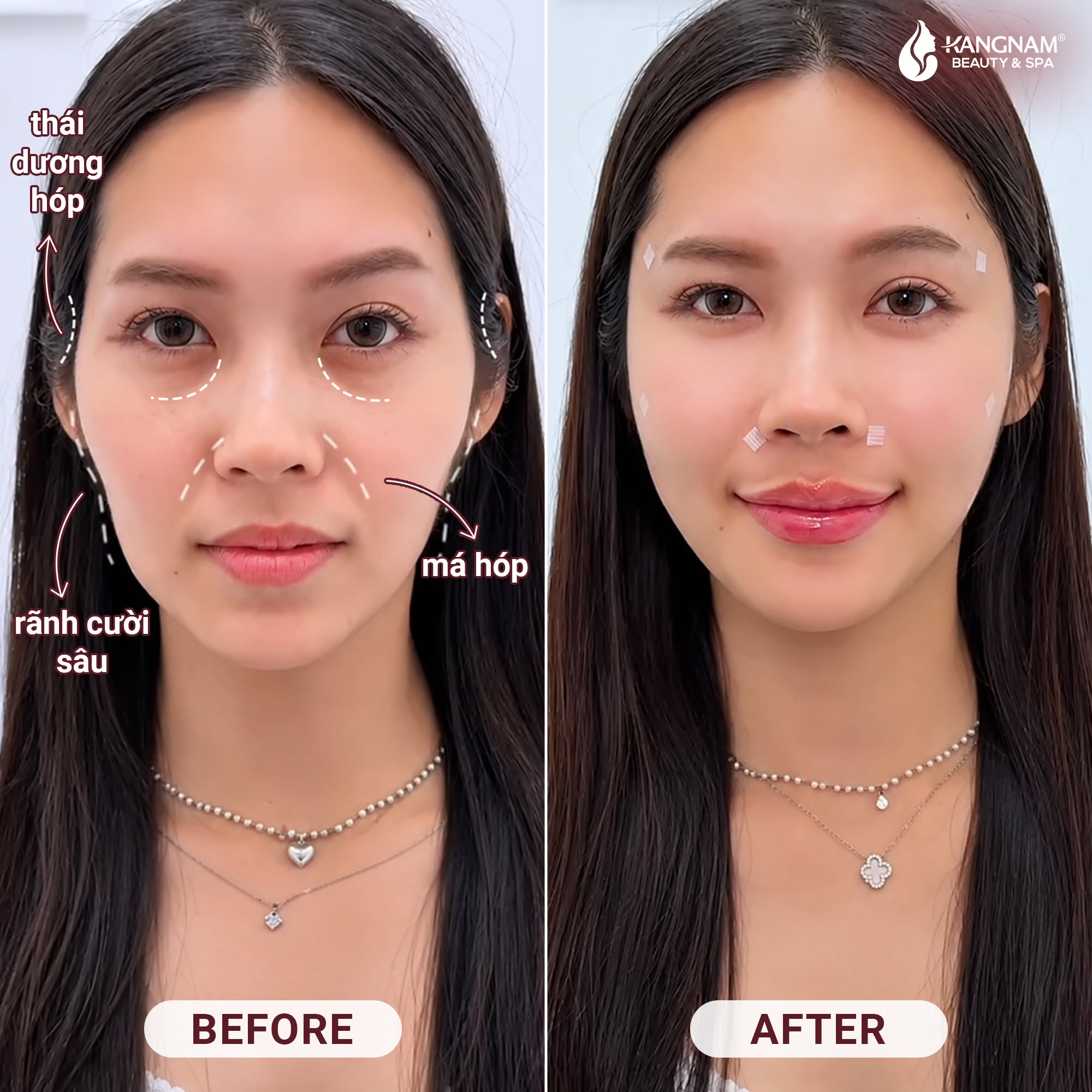Hình ảnh trước và sau cho thấy sự thay đổi tại vùng thái dương, má và rãnh cười sau khi thực hiện phương pháp trẻ hóa.