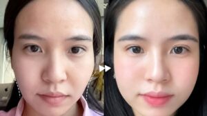 Trẻ hoá cho người 30 tuổi: Có vết chân chim nên làm gì?