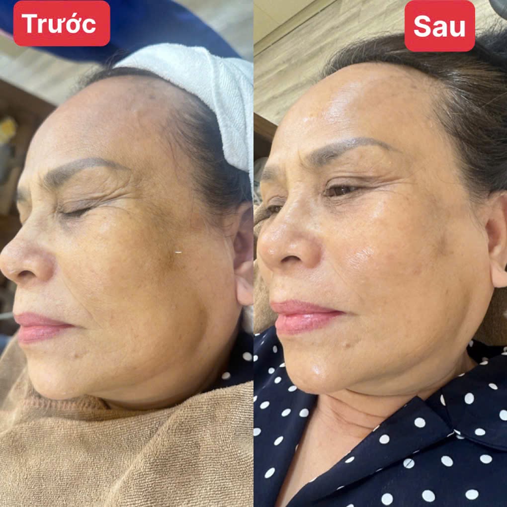 Tùy vào từng tình trạng đốm nâu ở mỗi người, bác sĩ sẽ lên phương pháp điều trị cụ thể