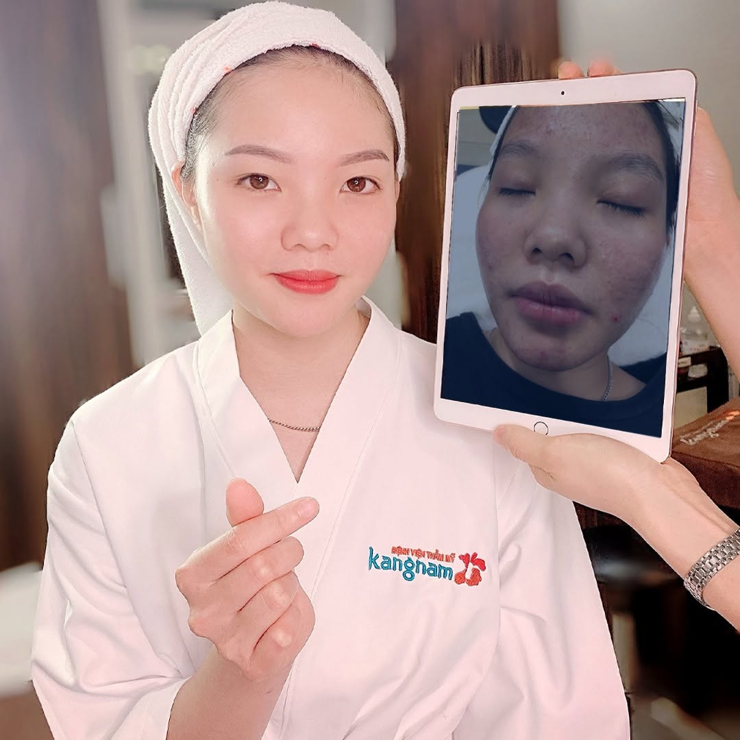 Kangnam trị mụn hiệu quả bằng các công nghệ hiện đại, phù hợp với tình trạng mỗi người