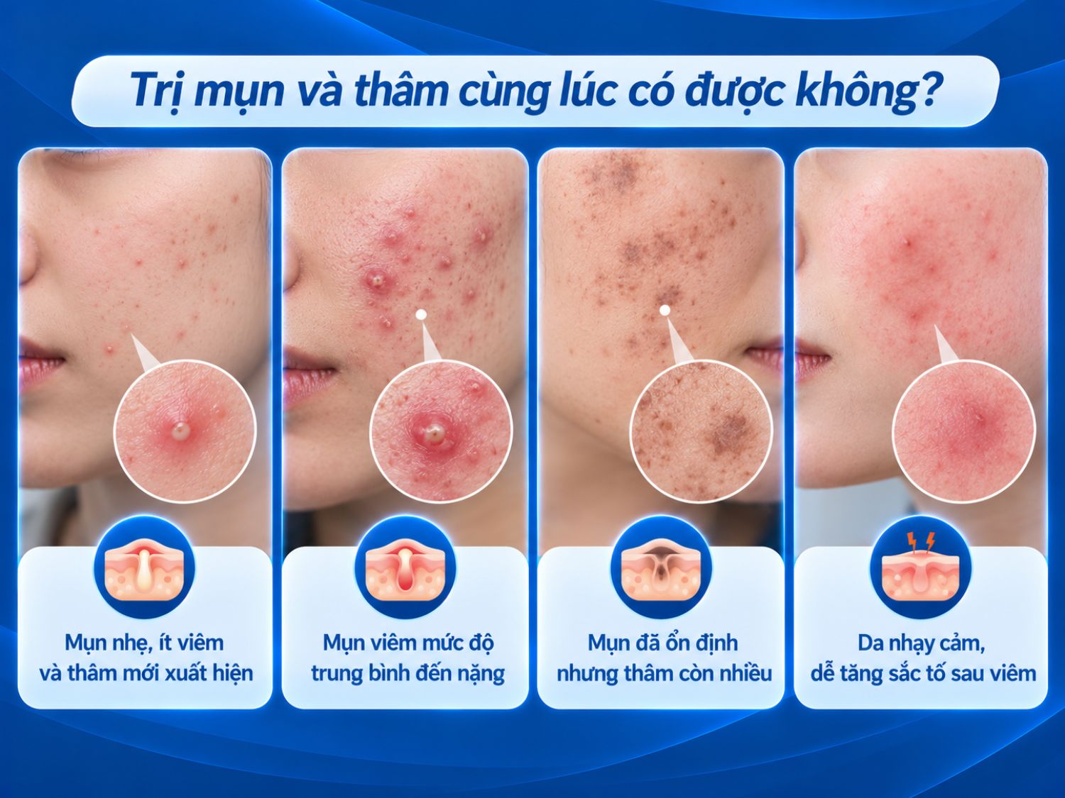 Trị mụn và thâm cùng lúc có thể thực hiện tùy tình trạng da. Bác sĩ sẽ đánh giá mức độ mụn viêm, thâm sau mụn và độ nhạy cảm của da để lựa chọn phác đồ phù hợp.