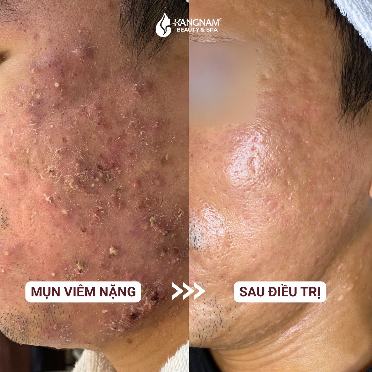 Kết quả trị mụn sau vài buổi điều trị tại Kangnam