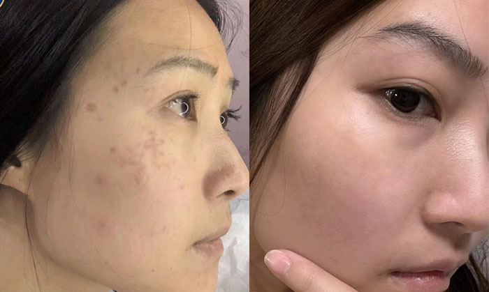 Ảnh trước - sau của khách trị nám sau sinh tại Kangnam