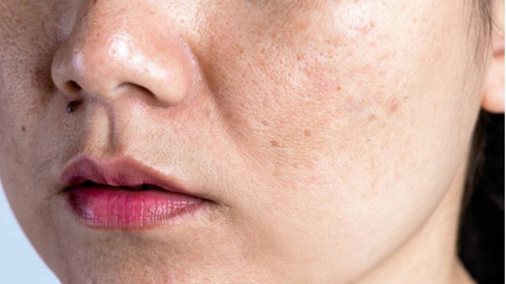 Trị nám ở bệnh viện da liễu công và viện thẩm mỹ giá khác nhau thế nào?
