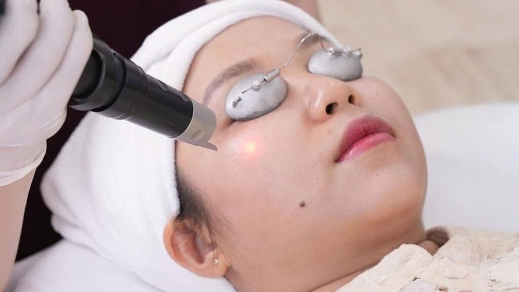 Trị nám bệnh viện da liễu: Nám 5 năm nên chọn bệnh viện công hay viện thẩm mỹ?