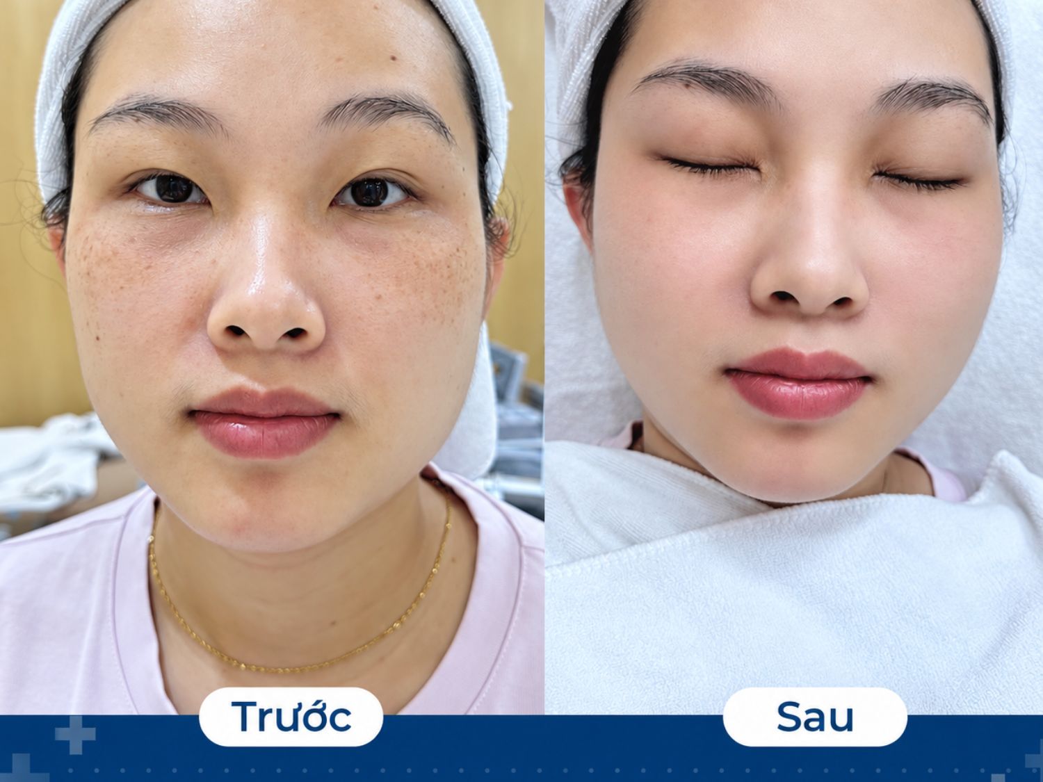 Làn da của khách hàng sau 1 buổi trị tàn nhang tại Kangnam