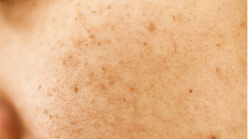 Trị tàn nhang một lần có hết không hay phải mua liệu trình?