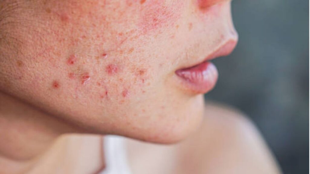 Trị thâm mụn bao nhiêu tiền một buổi ở bệnh viện?