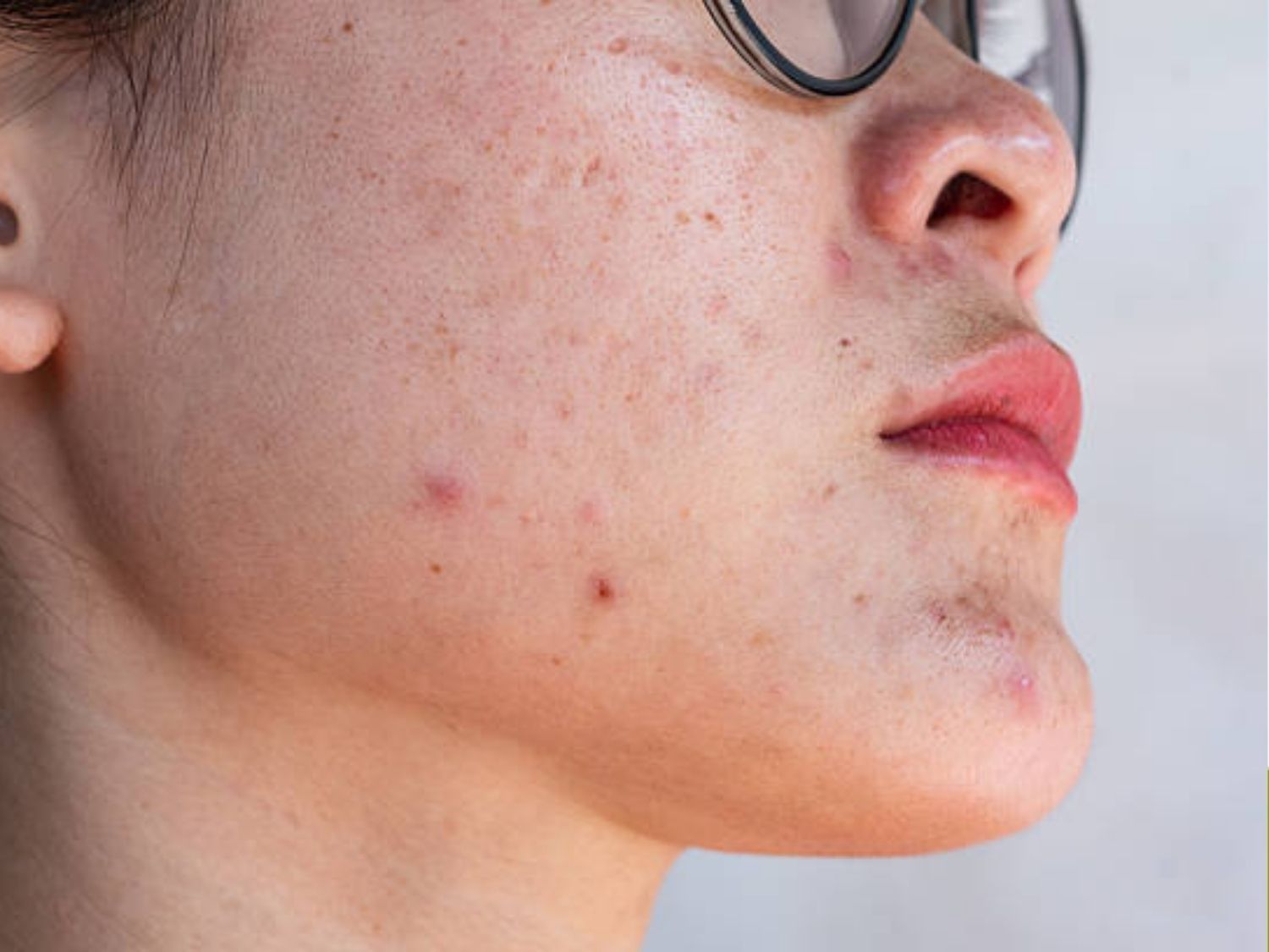 Tình trạng thâm mụn đỏ mới xuất hiện