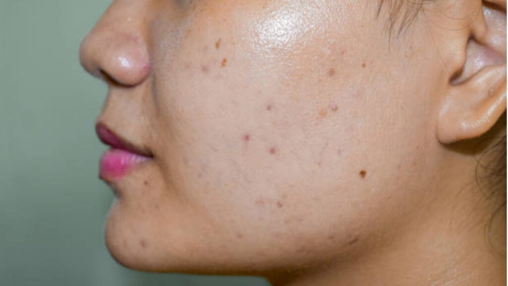 Trị thâm sau mụn bằng gì rẻ nhất, có cần bắn laser không?
