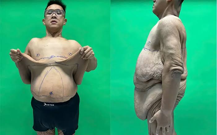 Trọng nhân trước khi cắt da thừa