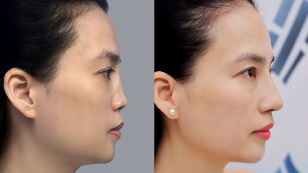 Bao nhiêu phần trăm người nâng mũi phải sửa lại? Khi nào cần tái phẫu thuật?