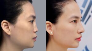 Bao nhiêu phần trăm người nâng mũi phải sửa lại? Khi nào cần tái phẫu thuật?