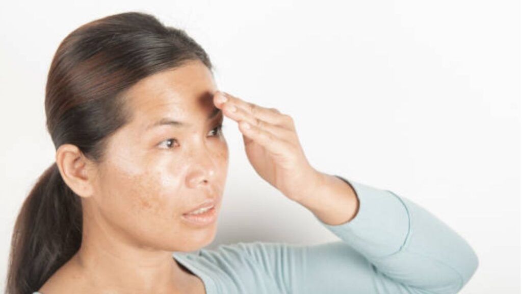 Ultherapy PRIME và Thermage FLX tại Kangnam có trị đốm nâu không?