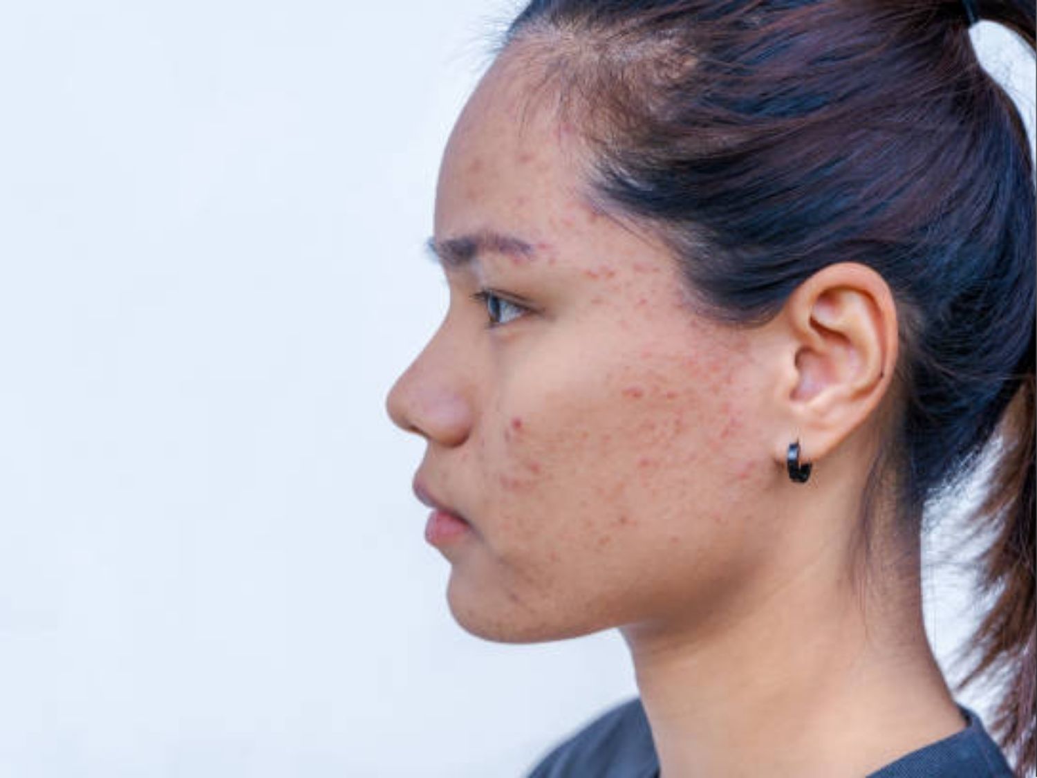 Đốm nâu do thâm mụn, nám
